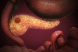 Un fármaco logra duplicar la supervivencia en cáncer de páncreas avanzado